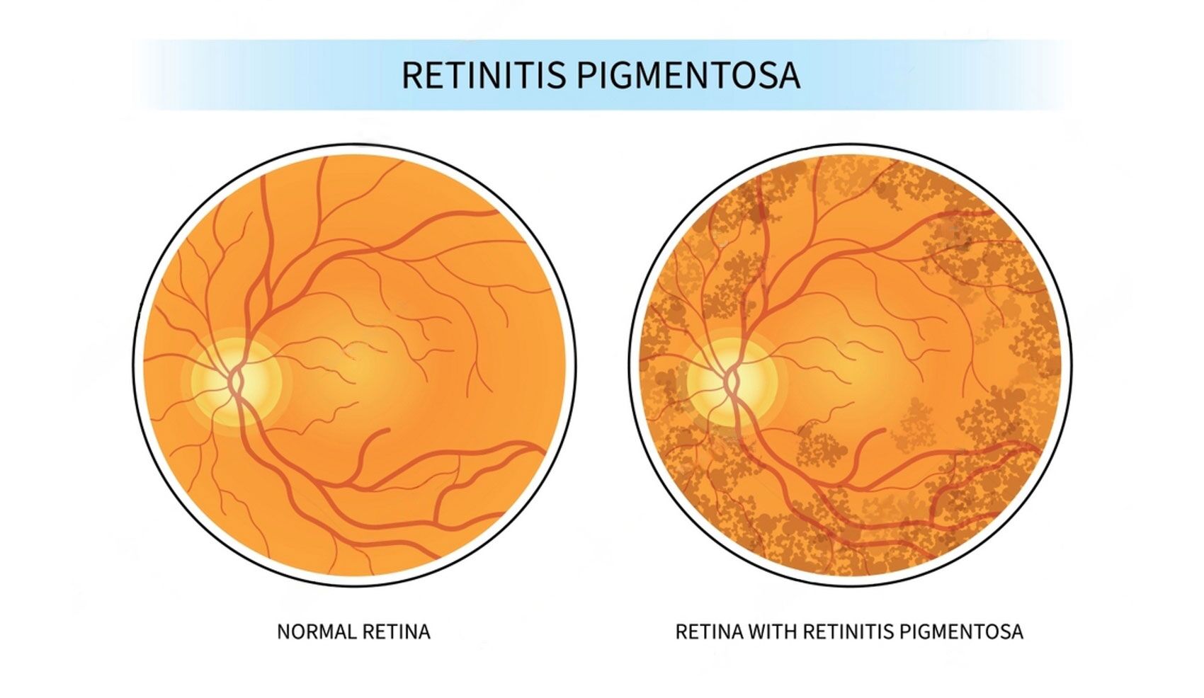 Retinit Degenerative Eye Conditions: Symptoms, Causes, and Treatment