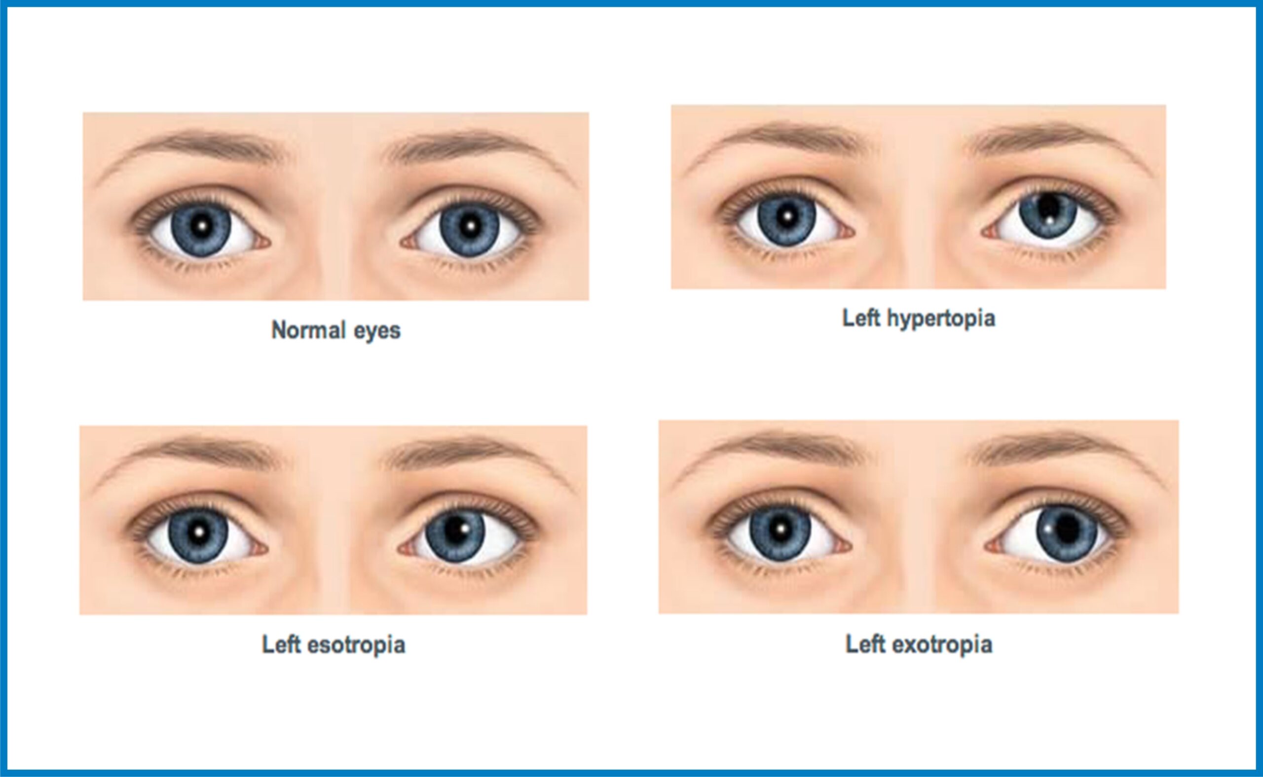 Children and Strabismus: Detecting and Managing Childhood Squint